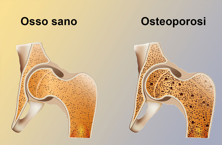 Cura Osteoporosi e prevenzione con Bioallenamento!